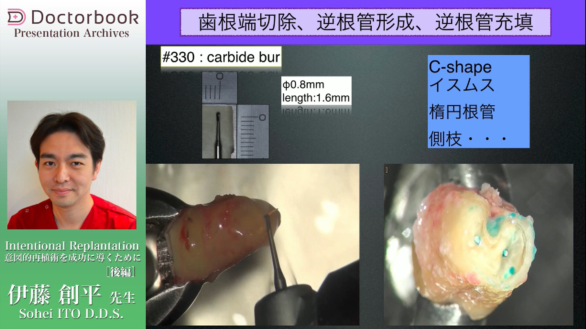 天然歯を限界まで残す！外科的歯内療法最前線 | Doctorbook academy